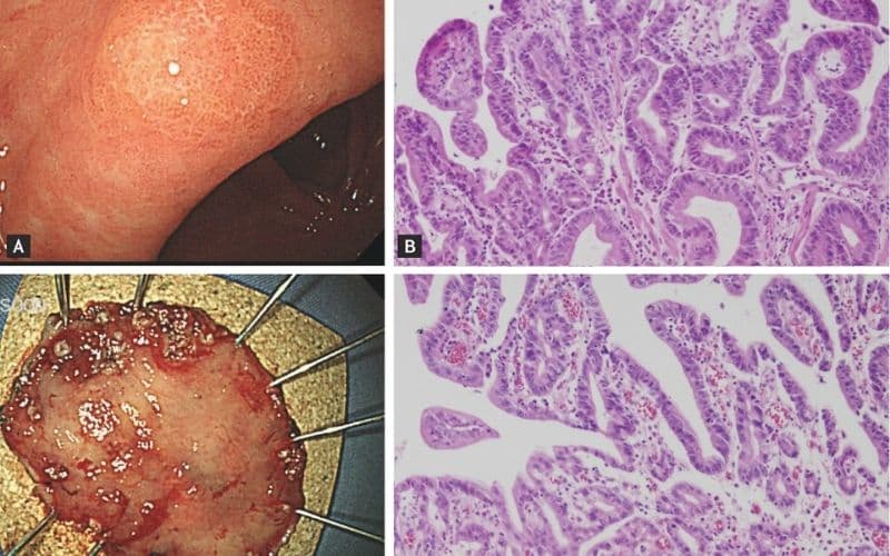 loạn sản niêm mạc dạ dày