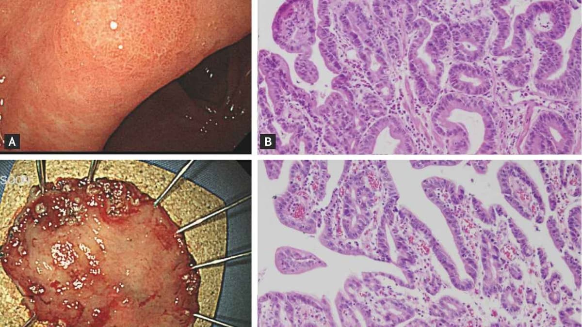 Loạn sản niêm mạc dạ dày nội soi có thấy không?