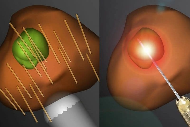 marker ung thư tiền liệt tuyến