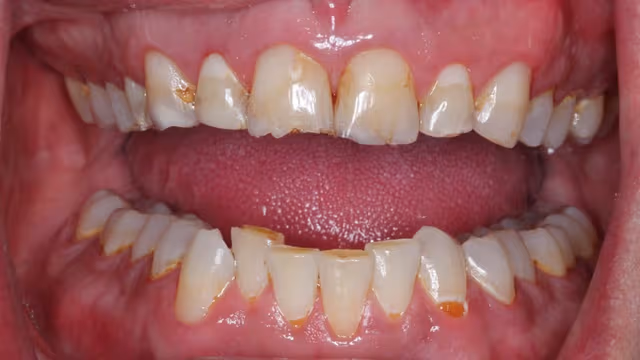 Men răng bị mòn gây ảnh hưởng gì?