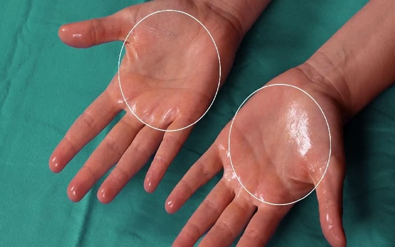 các phương pháp điều trị tăng tiết mồ hôi