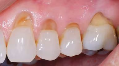 Mòn cổ răng là gì? Làm gì khi bị mòn cổ răng?