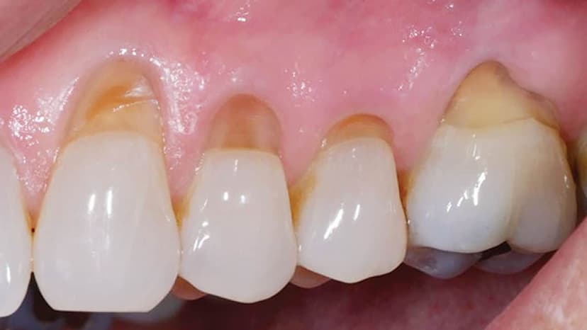 Mòn cổ răng là gì? Làm gì khi bị mòn cổ răng?