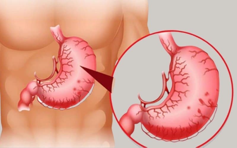 nguyên nhân bị teo niêm mạc dạ dày