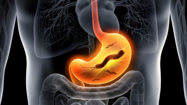 Nguyên nhân bị teo niêm mạc dạ dày là gì và những yếu tố nguy cơ cần biết