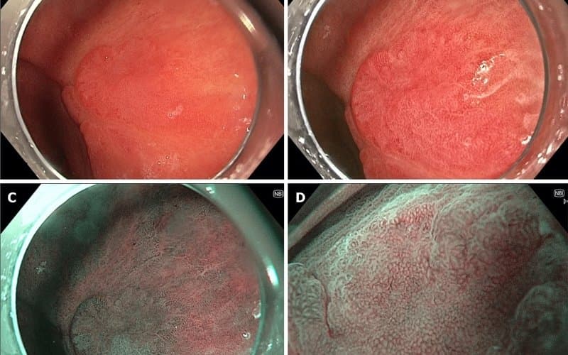 loạn sản niêm mạc dạ dày
