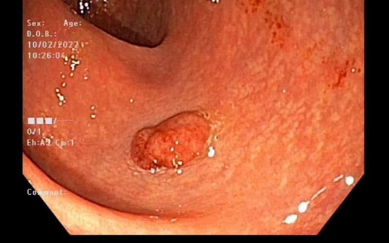 hình ảnh polyp đại tràng ác tính