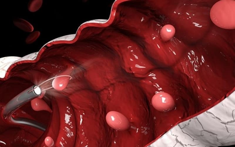 triệu chứng của polyp đại tràng ác tính