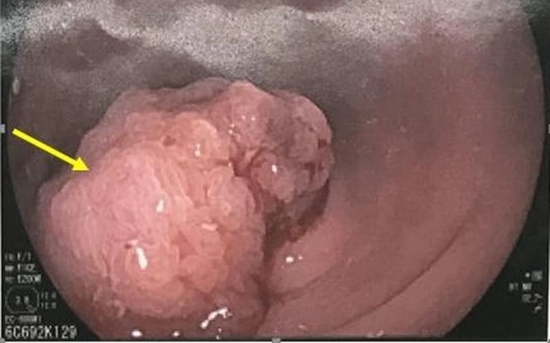 hình ảnh polyp đại tràng ác tính