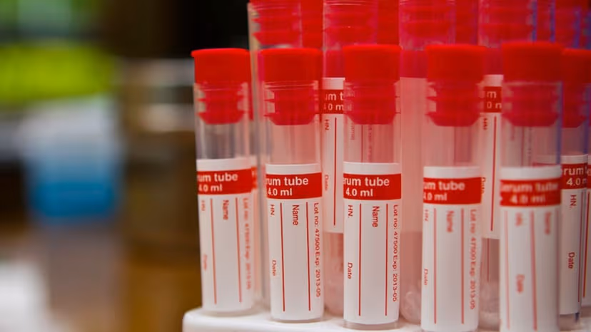 Tìm hiểu về marker ung thư tiền liệt tuyến