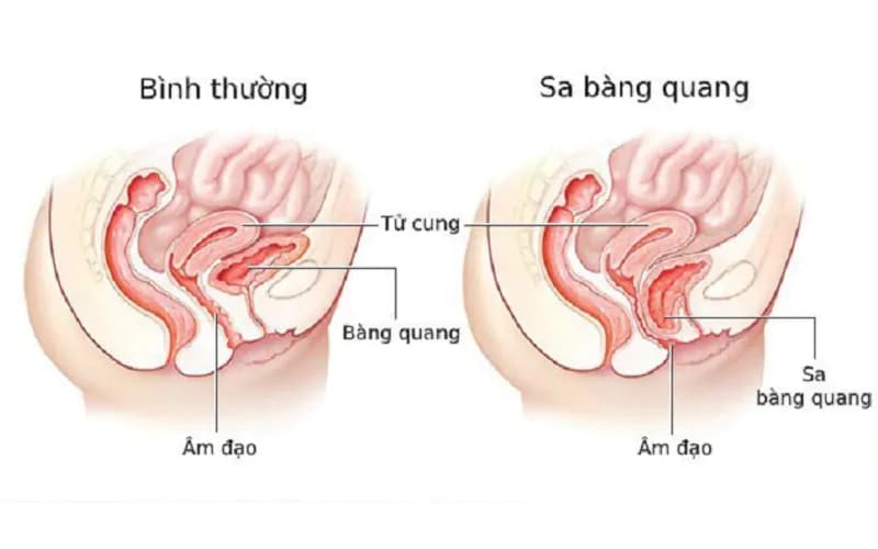 sa bàng quang khi mang thai
