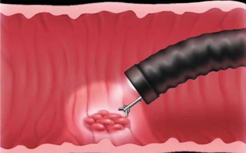 viêm teo niêm mạc dạ dày kèm chuyển sản ruột