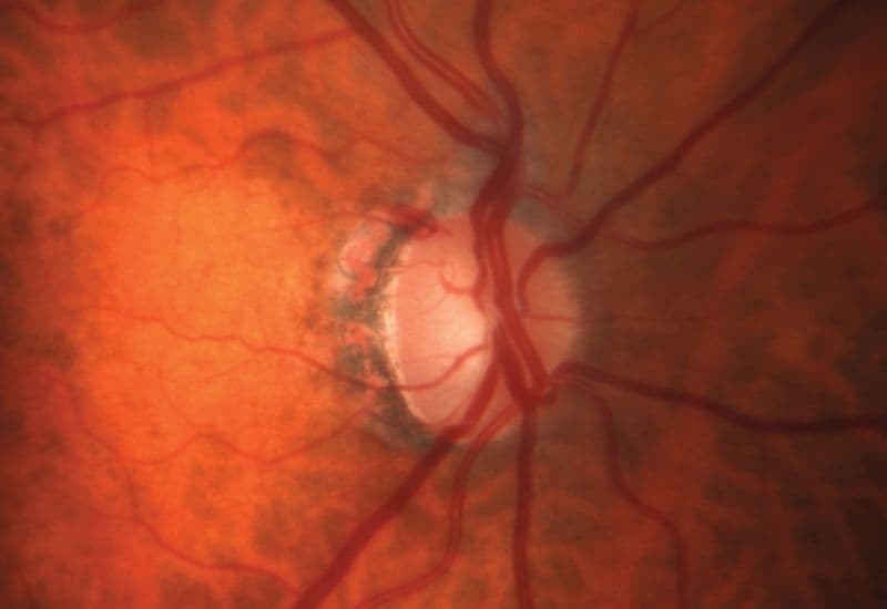 tăng nhãn áp góc đóng