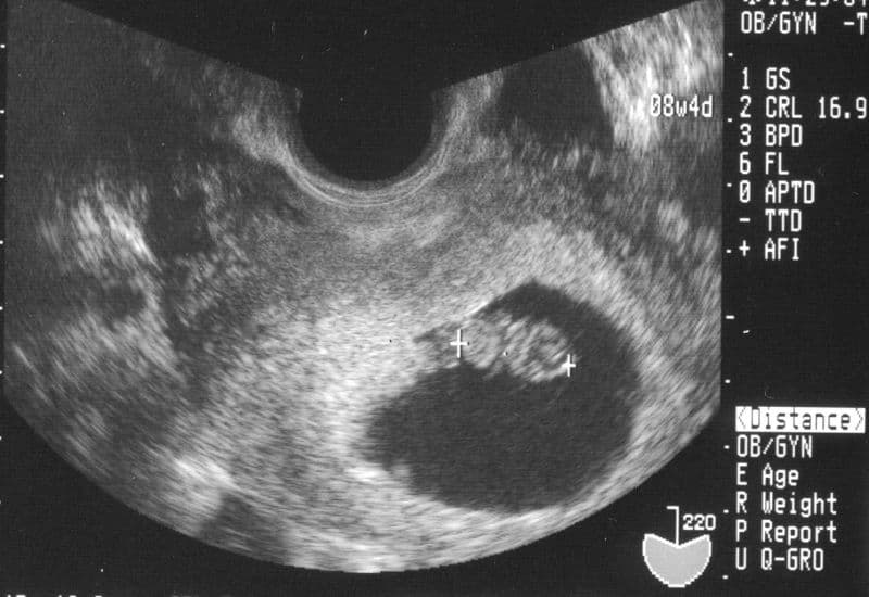 thai 8 tuần chiều dài đầu mông bao nhiêu