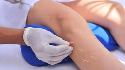 Thoái hóa khớp gối có châm cứu được không và những điều cần biết