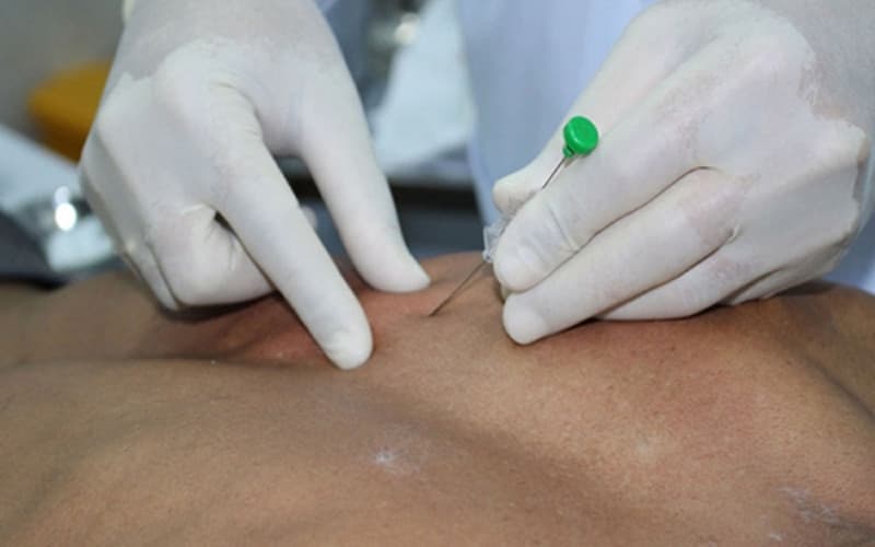 thủy châm có tác dụng gì