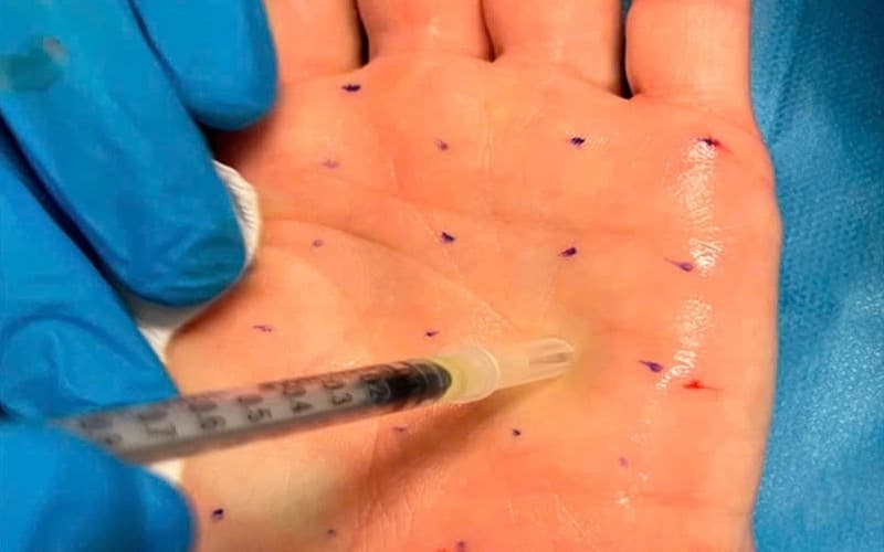 các phương pháp điều trị tăng tiết mồ hôi