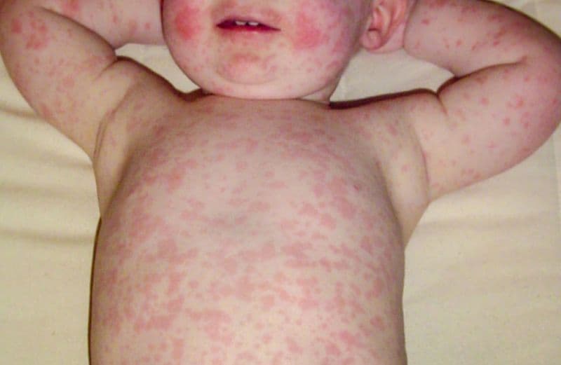 trẻ phát ban sau sốt có được tắm không