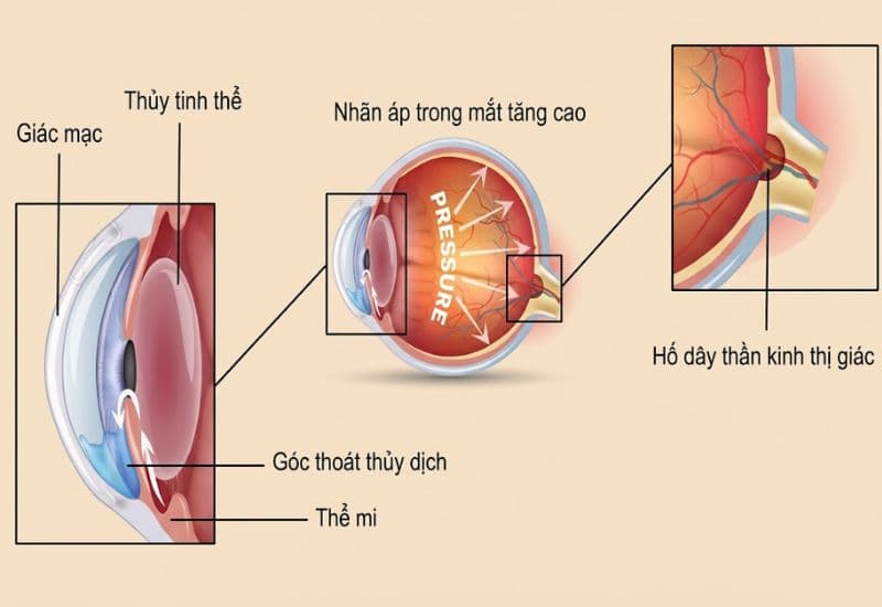 triệu chứng tăng nhãn áp