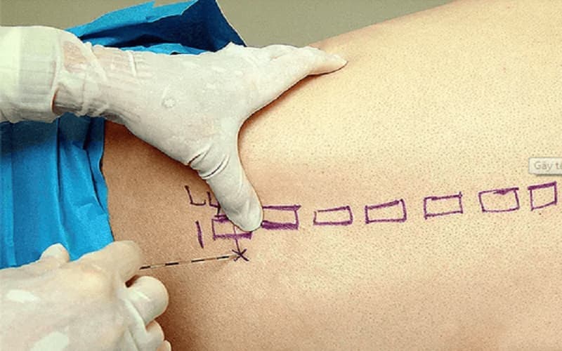 chống chỉ định gây tê tủy sống