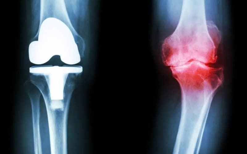 thoái hóa khớp gối có châm cứu được không