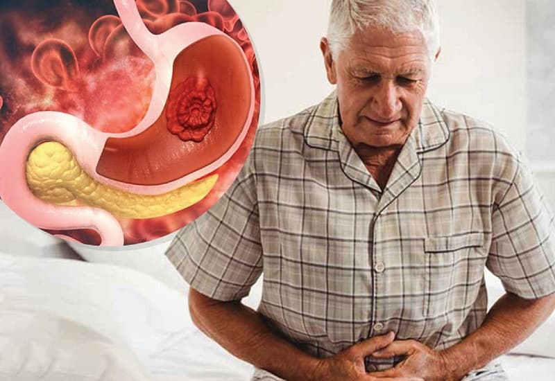 ung thư biểu mô tuyến dạ dày