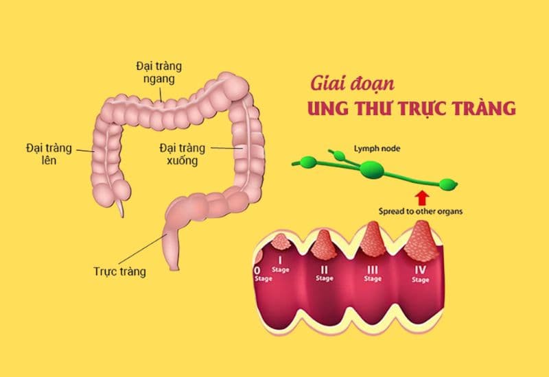 ung thư đại tràng phát triển trong bao lâu