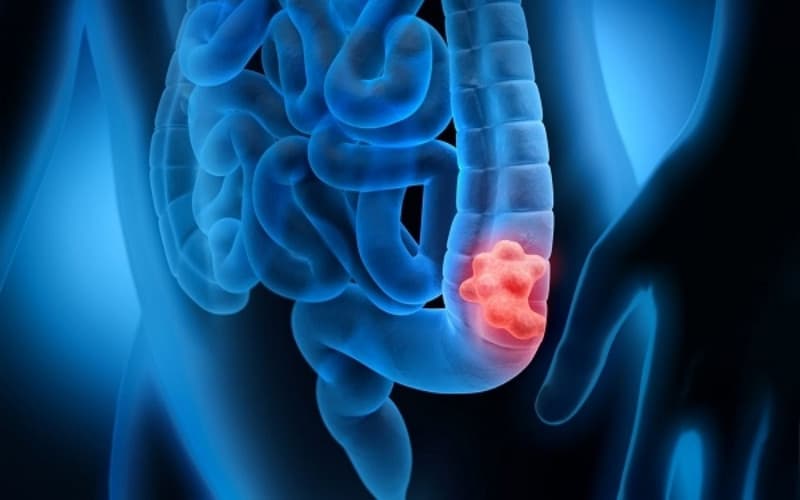 ung thư tiêu hóa có di truyền không