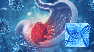 Ung thư tiêu hóa có di truyền không? Những điều cần biết để phát hiện sớm