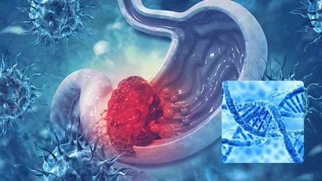 Ung thư tiêu hóa có di truyền không? Những điều cần biết để phát hiện sớm