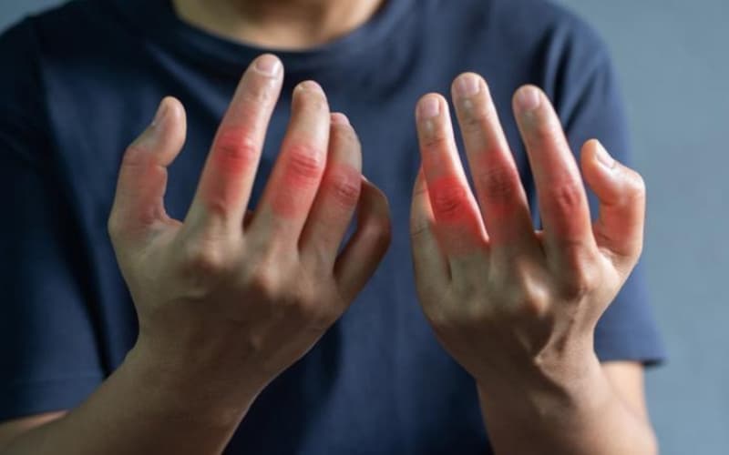 thủy châm điều trị viêm khớp dạng thấp