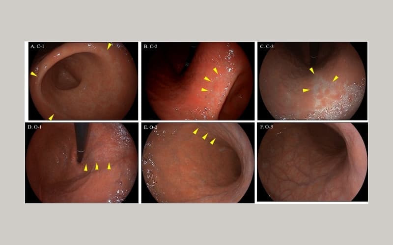 viêm teo niêm mạc dạ dày c1