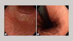 Viêm teo niêm mạc dạ dày C1 là gì và mức độ nguy hiểm cùng cách theo dõi