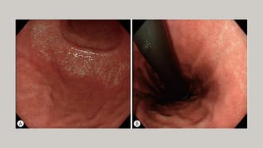 Viêm teo niêm mạc dạ dày C1 là gì và mức độ nguy hiểm cùng cách theo dõi