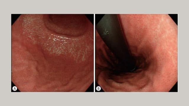 Viêm teo niêm mạc dạ dày C1 là gì và mức độ nguy hiểm cùng cách theo dõi