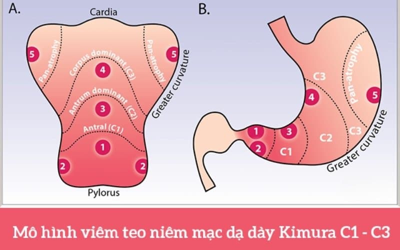 viêm teo niêm mạc dạ dày c1