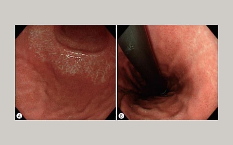 viêm teo niêm mạc dạ dày c1