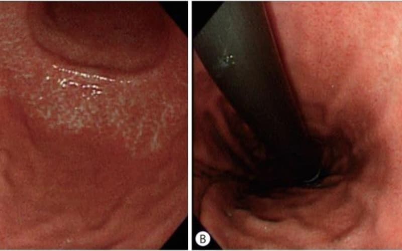 viêm teo niêm mạc dạ dày c2 là gì