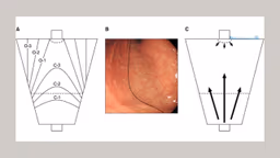 Viêm teo niêm mạc dạ dày C2 là gì và mức độ nguy hiểm