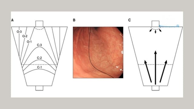 Viêm teo niêm mạc dạ dày C2 là gì và mức độ nguy hiểm