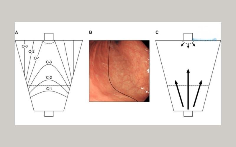 viêm teo niêm mạc dạ dày c2 là gì