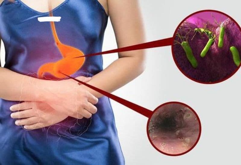 viêm teo niêm mạc dạ dày có chữa khỏi không