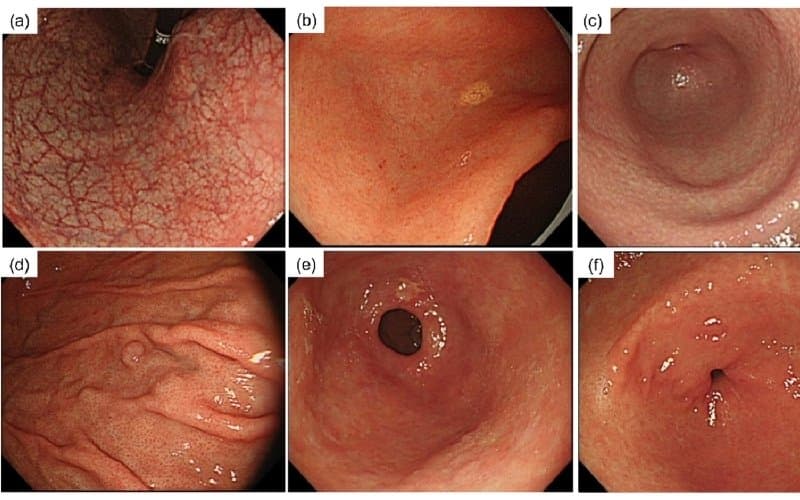 viêm teo niêm mạc dạ dày c2 là gì