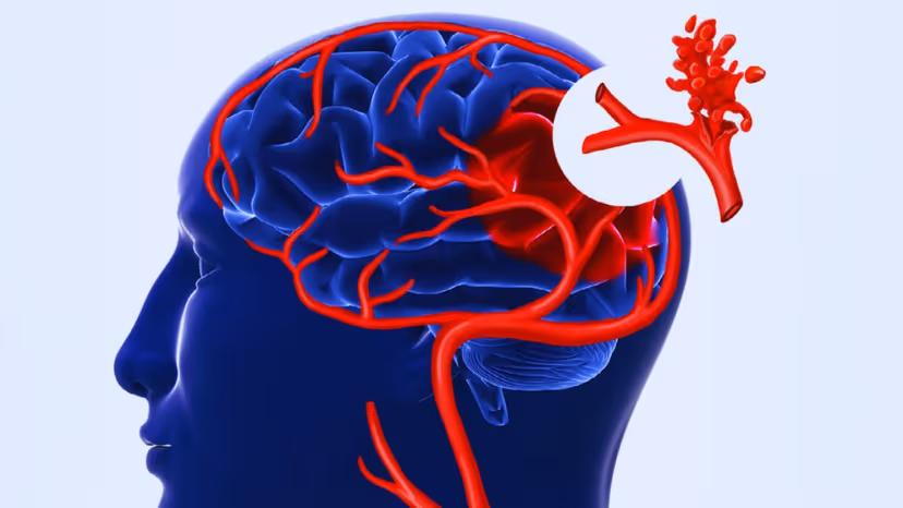 Đột quỵ xuất huyết não có nguy hiểm không?