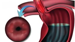 Barrett thực quản đoạn ngắn có nguy hiểm không, có cần điều trị không?