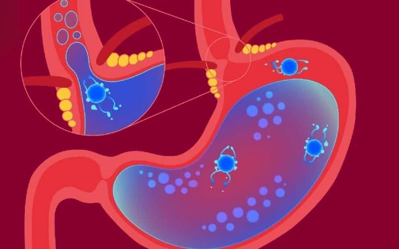 barrett thực quản đoạn ngắn có nguy hiểm không