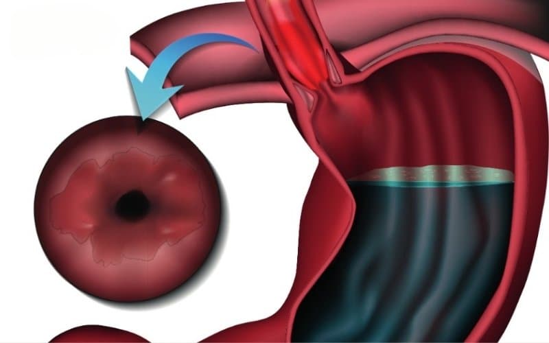 barrett thực quản đoạn ngắn có nguy hiểm không