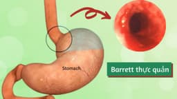 Barrett thực quản triệu chứng là gì, khi nào cần nội soi kiểm tra?