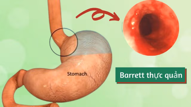 Barrett thực quản triệu chứng là gì, khi nào cần nội soi kiểm tra?