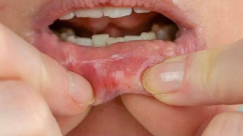 bệnh lậu lây trong bao lâu